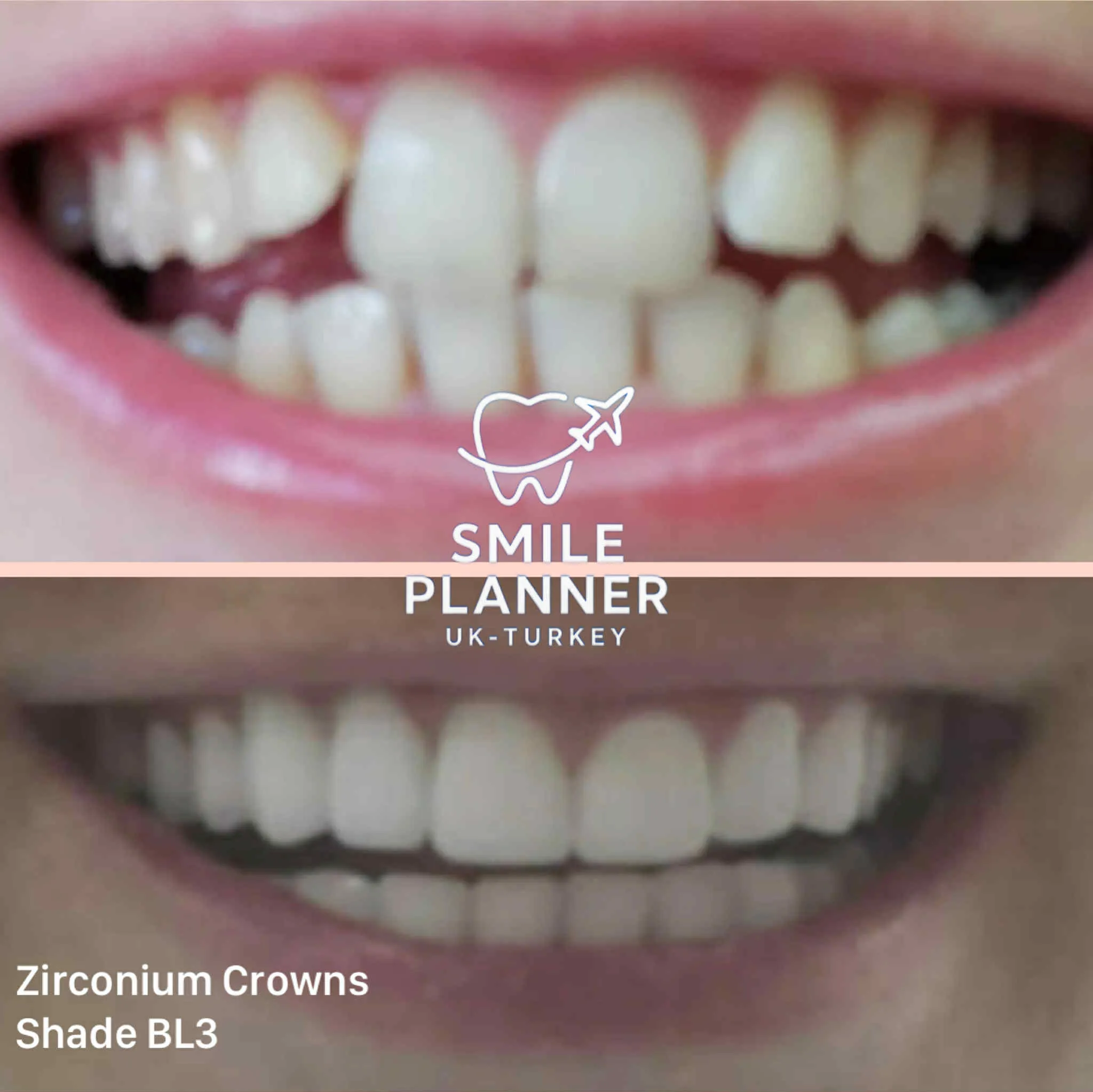 UK woman - smile transformation with zirconium crowns in Turkey
